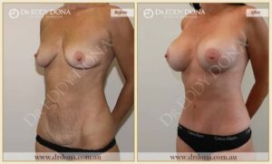 Dr Eddy Dona - Mummy Makeover - Before and After