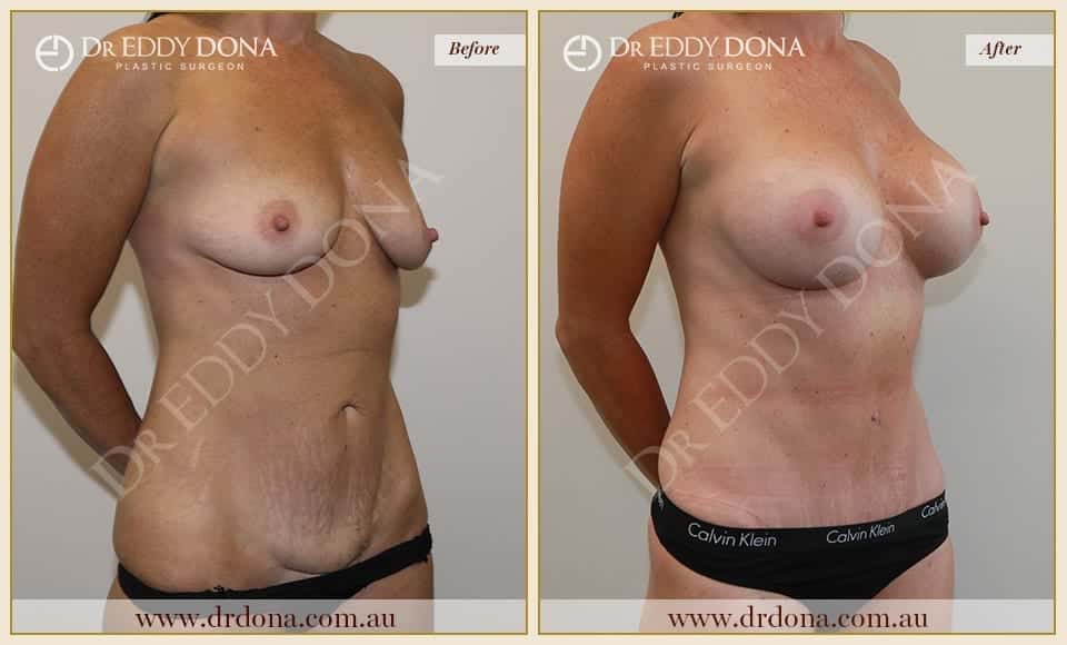 Dr Eddy Dona - Mummy Makeover - Before and After