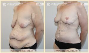 Dr Eddy Dona - Mummy Makeover - Before and After