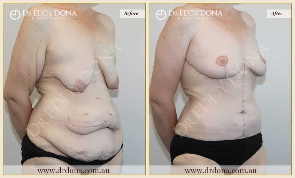 Dr Eddy Dona - Mummy Makeover - Before and After