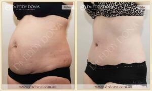 Dr Eddy Dona Plastic Surgery Tummy Tuck Before and After Left Oblique