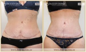 Dr Eddy Dona - Revision Tummy Tuck - Before and After