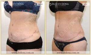 Dr Eddy Dona - Revision Tummy Tuck - Before and After