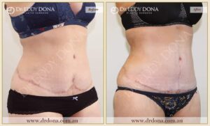 Dr Eddy Dona - Revision Tummy Tuck - Before and After