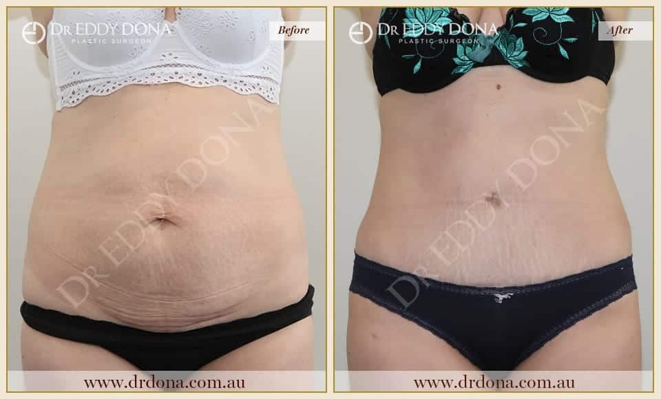 Dr Eddy Dona - Tummy Tuck - Before and After