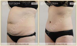 Dr Eddy Dona - Tummy Tuck - Before and After