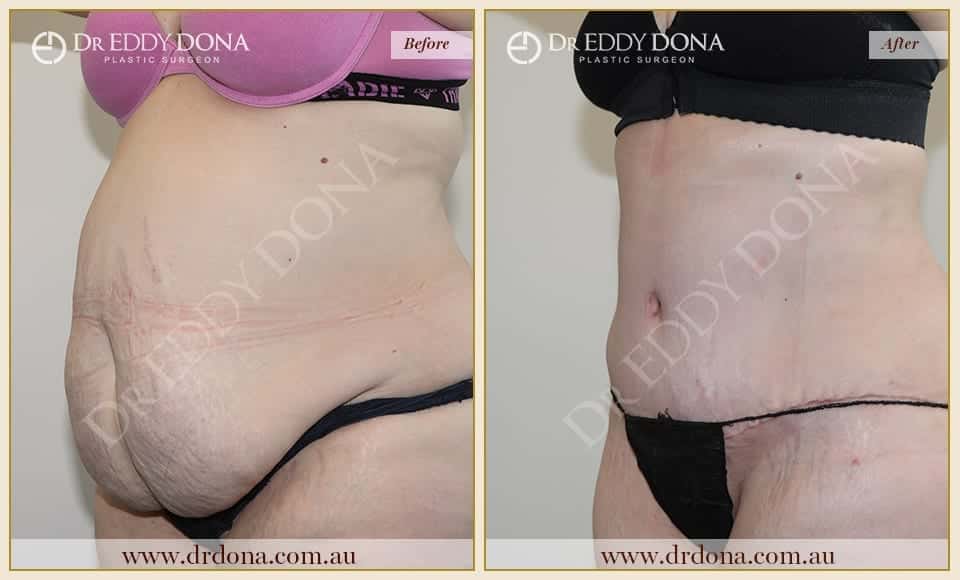 Dr Eddy Dona - Tummy Tuck - Before and After