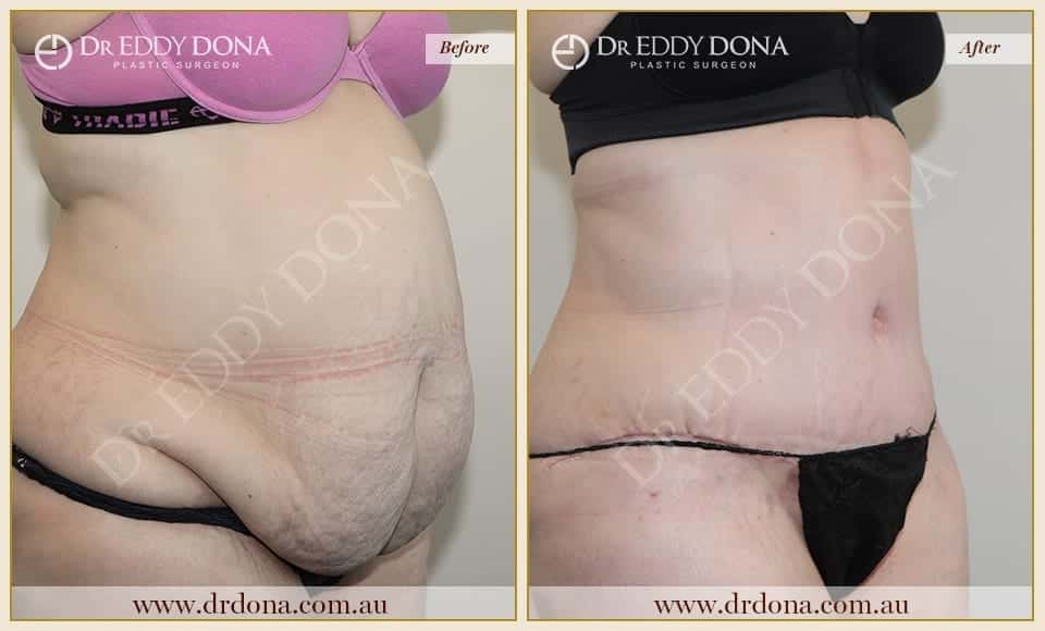 Dr Eddy Dona - Tummy Tuck - Before and After