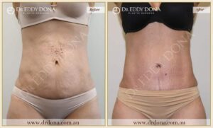 Dr Eddy Dona - Tummy Tuck - Before and After