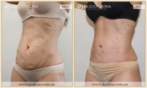 Dr Eddy Dona - Tummy Tuck - Before and After