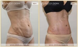 Dr Eddy Dona - Tummy Tuck - Before and After