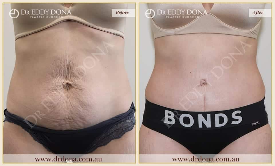 Dr Eddy Dona - Tummy Tuck - Before and After