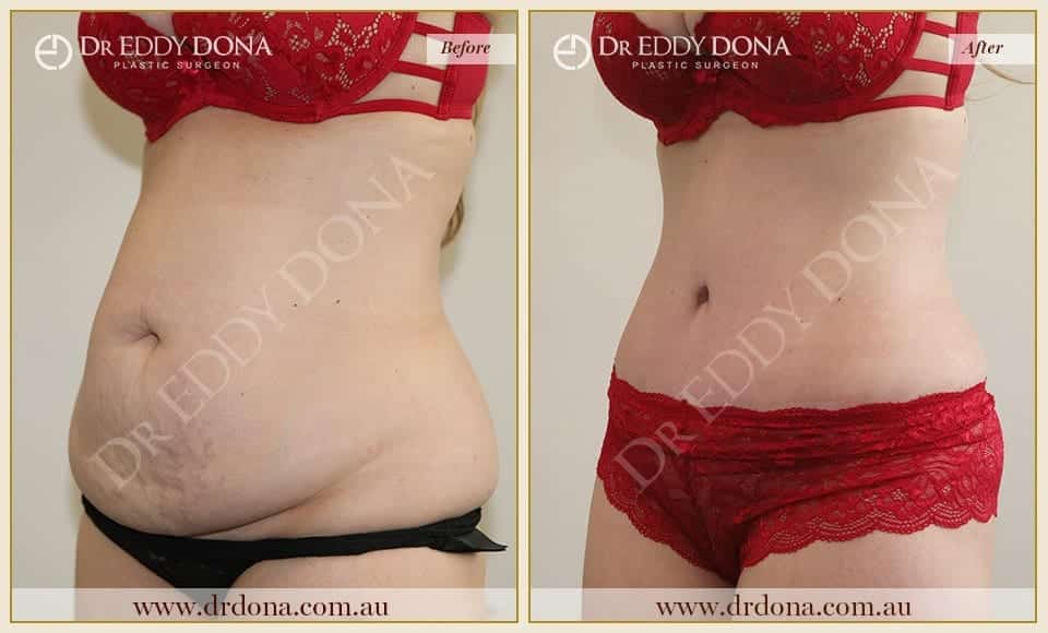 Dr Eddy Dona - Tummy Tuck - Before and After