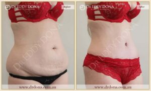 Dr Eddy Dona - Tummy Tuck - Before and After