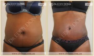 Dr Eddy Dona - Tummy Tuck - Before and After