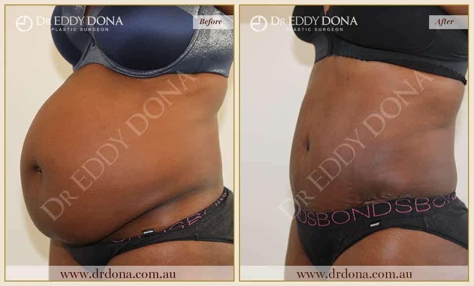 Dr Eddy Dona - Tummy Tuck - Before and After