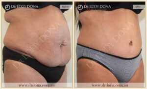 Dr Eddy Dona Plastic Surgery Tummy Tuck Before and After Right Oblique