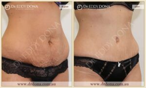 Dr Eddy Dona Plastic Surgery Tummy Tuck Before and After Right Oblique