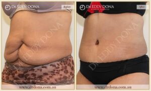 Dr Eddy Dona Plastic Surgery Tummy Tuck Before and After Left Oblique