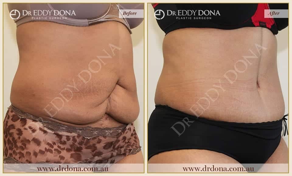 Dr Eddy Dona Plastic Surgery Tummy Tuck Before and After Right Oblique