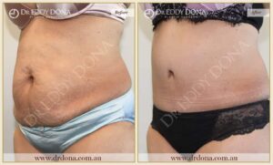 Dr Eddy Dona Plastic Surgery Tummy Tuck Before and After Left Oblique