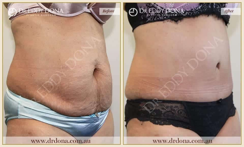 Dr Eddy Dona Plastic Surgery Tummy Tuck Before and After Right Oblique