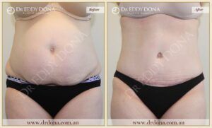 Dr Eddy Dona Plastic Surgery Tummy Tuck Before and After Frontal