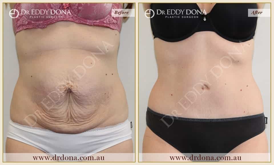 Dr Eddy Dona Plastic Surgery Tummy Tuck Before and After Frontal