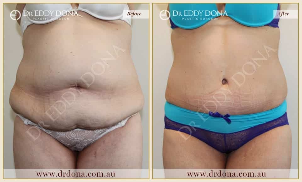 Dr Eddy Dona Plastic Surgery Tummy Tuck Before and After Frontal