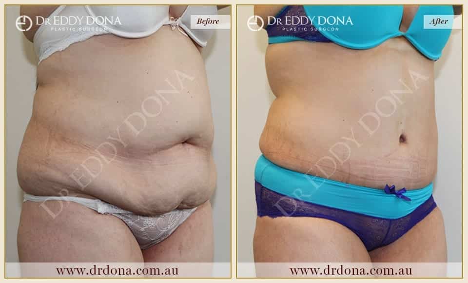 Dr Eddy Dona Plastic Surgery Tummy Tuck Before and After Right Oblique