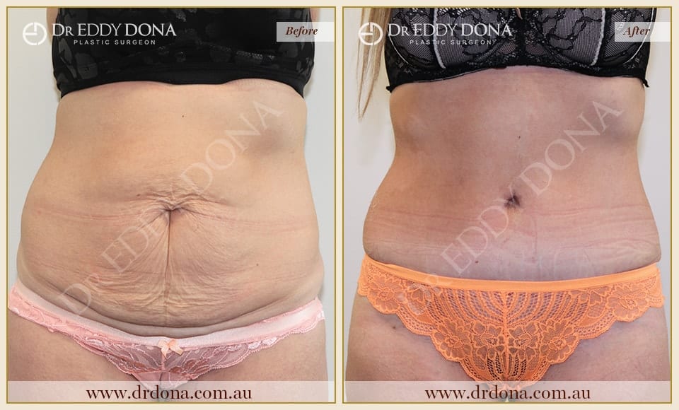 Dr Eddy Dona Plastic Surgery Tummy Tuck Before and After Frontal