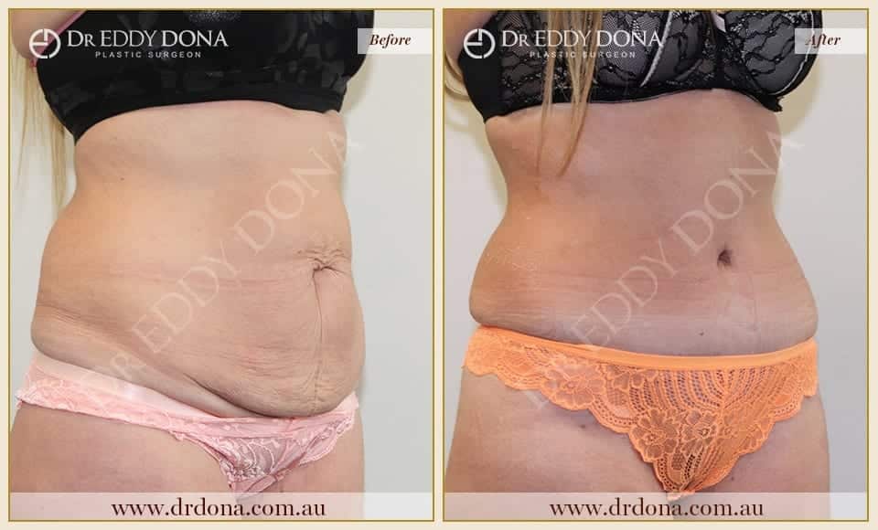 Dr Eddy Dona Plastic Surgery Tummy Tuck Before and After Right Oblique