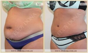 Dr Eddy Dona Plastic Surgery Tummy Tuck Before and After Left Oblique