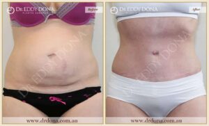 Dr Eddy Dona Plastic Surgery Tummy Tuck Before and After Frontal