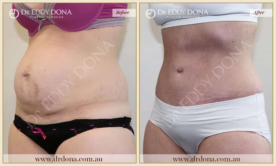 Dr Eddy Dona Plastic Surgery Tummy Tuck Before and After Left Oblique