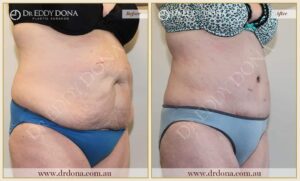 Dr Eddy Dona Plastic Surgery Tummy Tuck Before and After Right Oblique