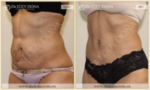 Dr Eddy Dona Plastic Surgery Tummy Tuck Before and After Left Oblique