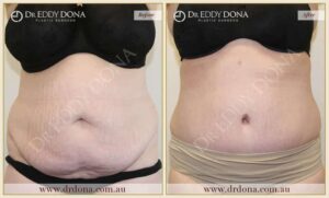 Dr Eddy Dona Plastic Surgery Tummy Tuck Before and After Frontal