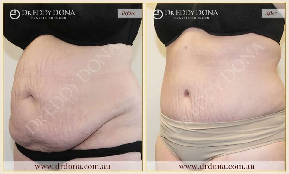 Dr Eddy Dona Plastic Surgery Tummy Tuck Before and After Left Oblique