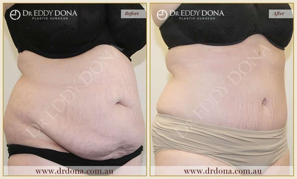 Dr Eddy Dona Plastic Surgery Tummy Tuck Before and After Right Oblique