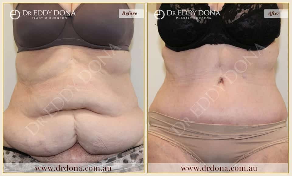 Dr Eddy Dona Plastic Surgery Tummy Tuck Before and After Frontal