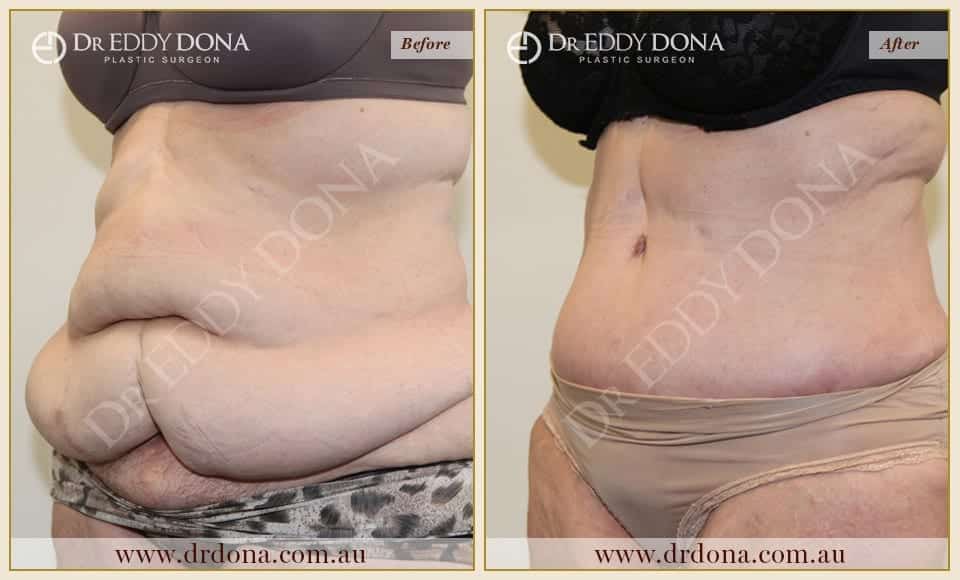 Dr Eddy Dona Plastic Surgery Tummy Tuck Before and After Left Oblique