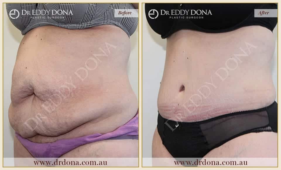 Dr Eddy Dona Plastic Surgery Tummy Tuck Before and After Left Oblique