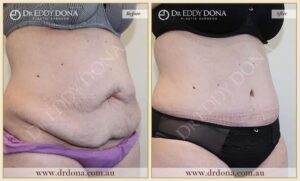 Dr Eddy Dona Plastic Surgery Tummy Tuck Before and After Right Oblique