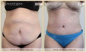 Dr Eddy Dona Plastic Surgery Tummy Tuck Before and After Frontal