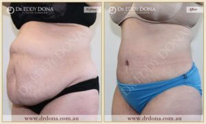 Dr Eddy Dona Plastic Surgery Tummy Tuck Before and After Left Oblique