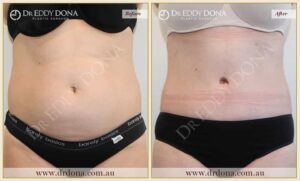 Dr Eddy Dona Plastic Surgery Tummy Tuck Before and After Frontal