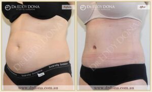 Dr Eddy Dona Plastic Surgery Tummy Tuck Before and After Left Oblique