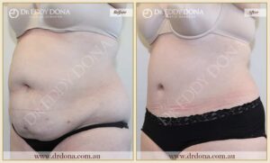 Dr Eddy Dona Plastic Surgery Tummy Tuck Before and After Left Oblique