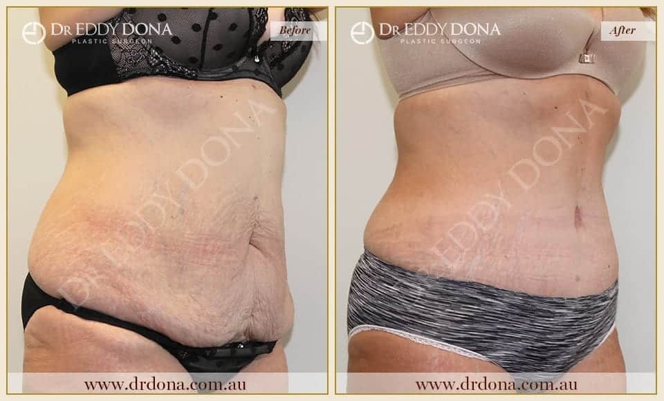 Dr Eddy Dona Plastic Surgery Tummy Tuck Before and After Right Oblique